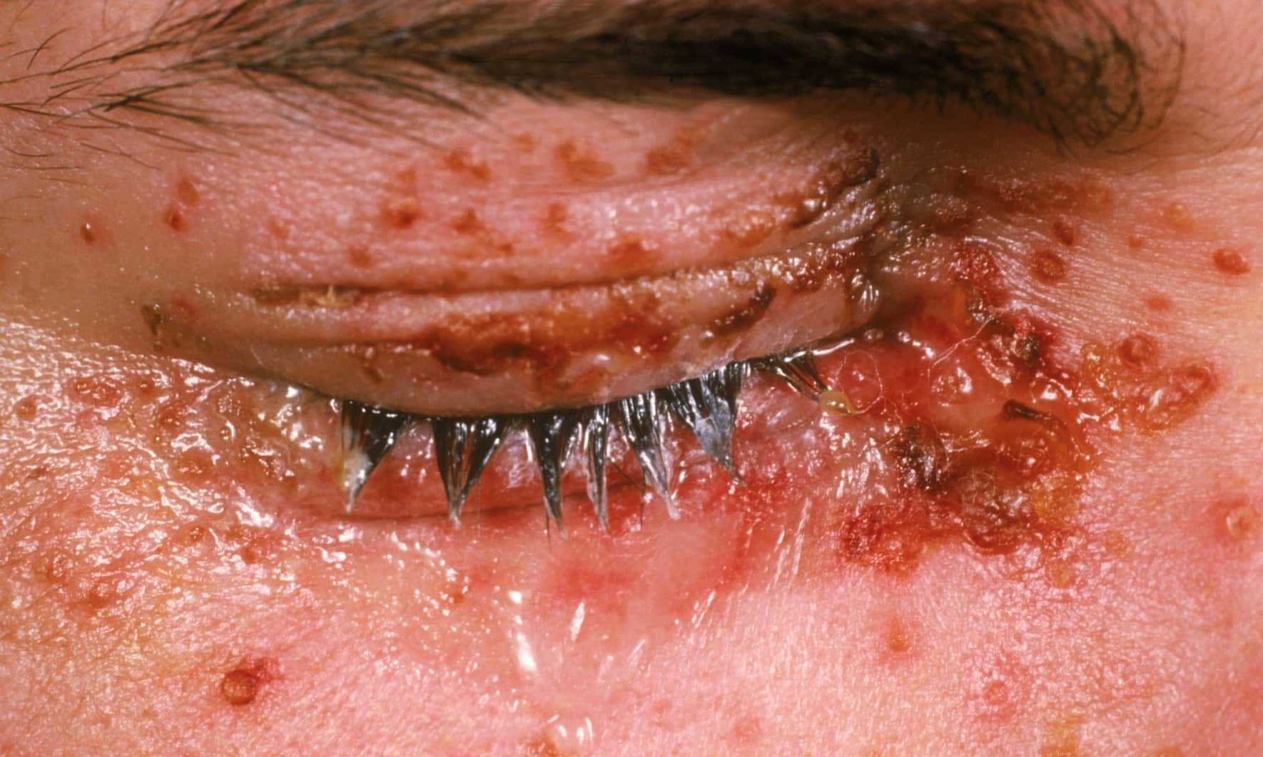 herpes symptom pictures #10