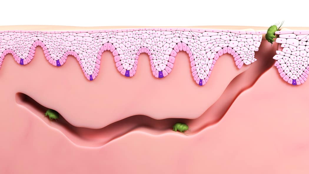 Krätze bei Kindern – oft zu spät bemerkt Computer-Darstellung von Krätze-Milben unter der Haut.