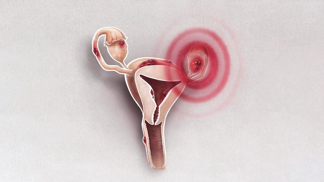 Eine Strategie gegen das Unwissen Eine Endometriose äussert sich dadurch, dass wucherndes Gewebe ausserhalb der Gebärmutter – etwa an Eierstöcken, im Beckenraum, am Darm oder am Bauchfell – wächst. Da eine Endometriose als Krankheit schwierig zu diagnostizieren ist, fordert der Ständerat nun einen Bericht mit Massnahmen, wie eine Endometriose frühzeitig erkannt und behandelt werden soll.