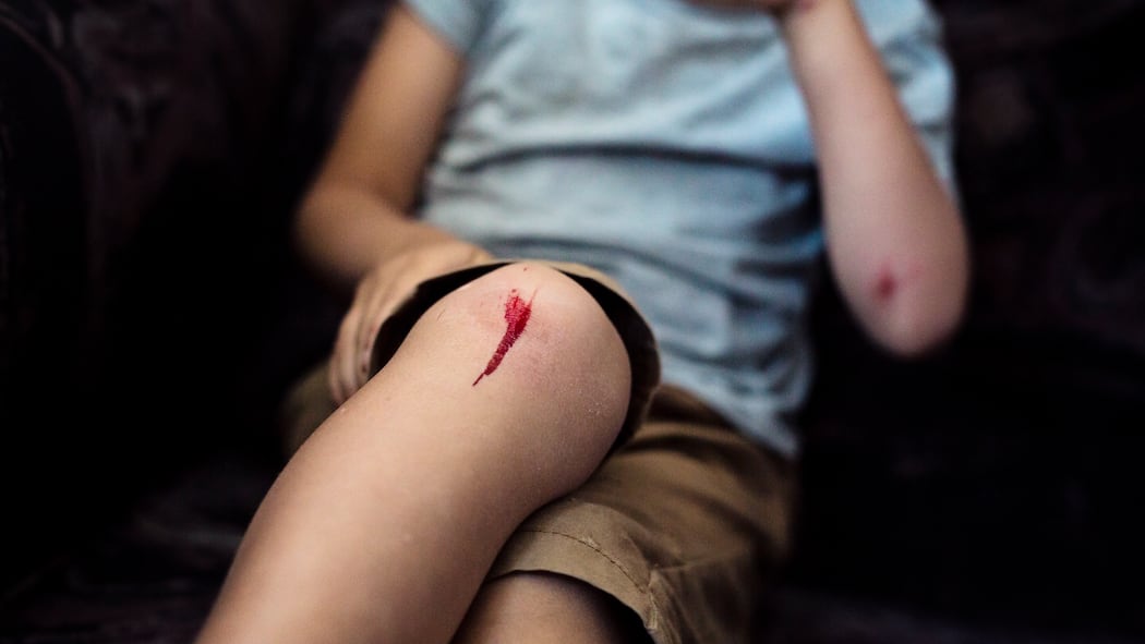 7 Antworten zu Hemgenix, dem teuersten Medikament der Welt Junge mit aufgeschürftem Knie. Kindern und Jugendlichen kann Hemgenix nicht verabreicht werden.