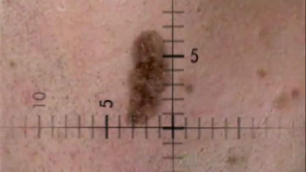 Woran erkennt man Hautkrebs? Hautkrebs