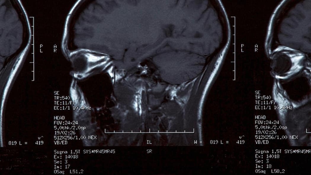 Wann Kopfweh gefährlich wird MRT-Bilder vom Kopf