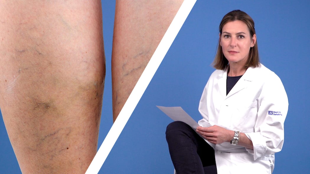 Führen übereinander geschlagene Beine zu Besenreisern? Dr. Claudia Twerenbold sitzt mit übereinander geschlagenen Beinen auf einem Stuhl.