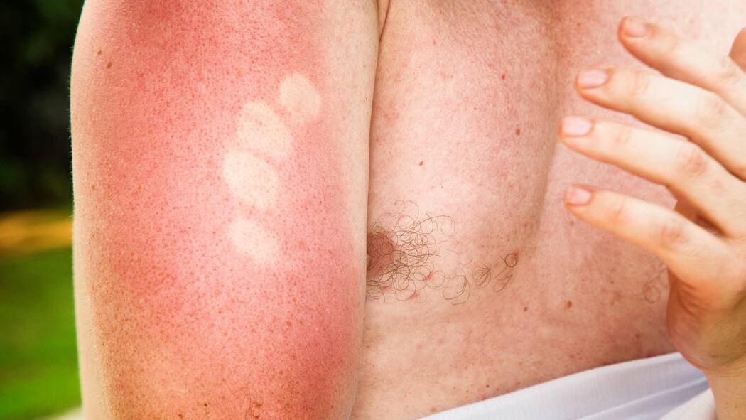 Was wirklich hilft, wenn die Haut rot ist Was hilft gegen Sonnenbrand?