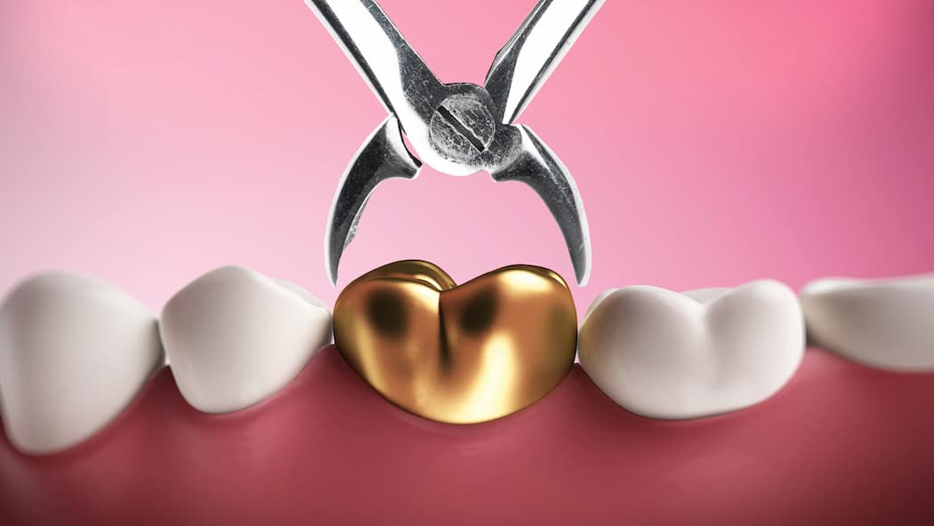 Warum Zahnärzte noch teurer werden Goldener Zahn in einer Zange