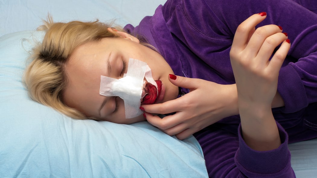 Muss ich für die Operation Ferien nehmen? Eine Frau liegt mit einer bandagierten Nase auf einem Spitalbett - Muss eine Angestellte wegen einer geplanten Operation Ferientage beziehen? Der Beobachter erklärt, was arbeitsrechtlich gilt.