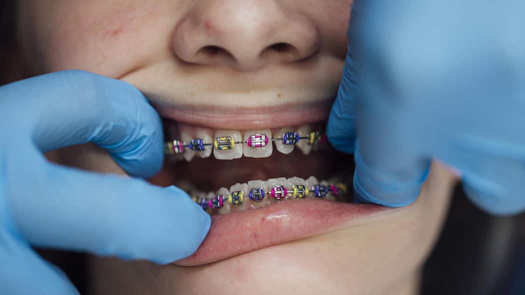 So schummeln Zahnärzte auf Kosten der Eltern A close up of a teenage girl who is at an orthodontists appointment. She is having her fixed retainer checked and adjusted. Her retainer is a fixed brace with rubber bands in place to keep them progressing.