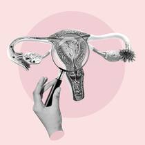 Ständerat: Keine Forschung für 200’000 Frauen Illustration einer Untersuchung der Gebärmutter. Bei vielen Betroffenen wird die Krankheit Endometriose nie diagnostiziert.