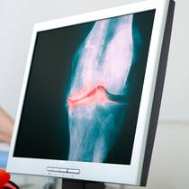 Glaubenskrieg um neue Arthrose-Therapie Ein Arzt zeigt seiner Patientin das Röntgenbild ihrer Arthrose.