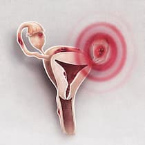 Eine Strategie gegen das Unwissen Eine Endometriose äussert sich dadurch, dass wucherndes Gewebe ausserhalb der Gebärmutter – etwa an Eierstöcken, im Beckenraum, am Darm oder am Bauchfell – wächst. Da eine Endometriose als Krankheit schwierig zu diagnostizieren ist, fordert der Ständerat nun einen Bericht mit Massnahmen, wie eine Endometriose frühzeitig erkannt und behandelt werden soll.