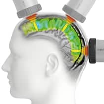 Mit Stosswellen fürs Hirn Alzheimer behandeln? Illustration Stimulation des Gehirns mithilfe des Geräts Neurolith von Storz Medical. Eine Thurgauer Firma verkauft ein Gerät, das Alzheimer stoppen und teils rückgängig machen soll. Eine Weltsensation – wenn es denn wahr wäre.