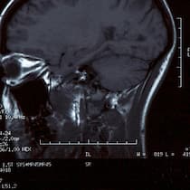 Wann Kopfweh gefährlich wird MRT-Bilder vom Kopf