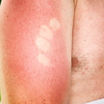 Was wirklich hilft, wenn die Haut rot ist Was hilft gegen Sonnenbrand?