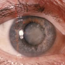 Operation kann ins Auge gehen Das Auge einer älteren Person mit grauem Star.