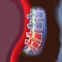 Blockade im Rücken Aufnahme einer Wirbelsäule, deren Bandscheiben beschädigt sind.