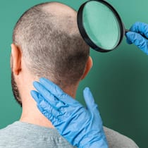 Das dicke Geschäft mit dem Haarausfall Trichologist examines the area of baldness on the client's head with a magnifying glass. Back view. Green background. The concept of alopecia and aesthetic medicine.