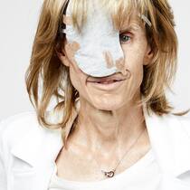 Sie setzt mit ihrem Gesicht ein Zeichen Nominiert für den Prix Courage 2020: Susi Schildknecht