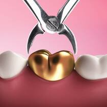 Warum Zahnärzte noch teurer werden Goldener Zahn in einer Zange