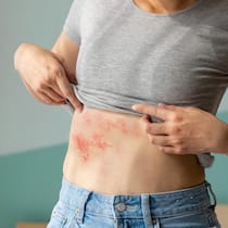 So schützen Sie sich vor Gürtelrose Frau mit Gürtelrose auf der Haut, sie hat sehr starke Schmerzen.