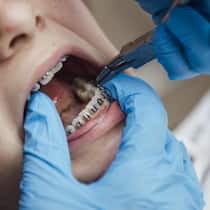 Zahnärzte verrechnen Millionen zu viel – so funktioniert der Abrechnungstrick A close up of a teenage girl who is at an orthodontists appointment. She is having her fixed retainer checked and adjusted seeing how her teeth are progressing. The unrecognisable dentist is wearing blue surgical gloves for the examination.