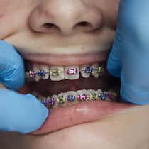 So schummeln Zahnärzte auf Kosten der Eltern A close up of a teenage girl who is at an orthodontists appointment. She is having her fixed retainer checked and adjusted. Her retainer is a fixed brace with rubber bands in place to keep them progressing.