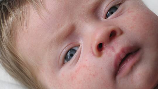 Wenn die Haut rebelliert