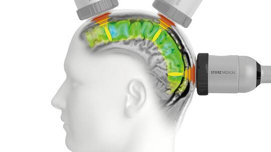 Illustration Stimulation des Gehirns mithilfe des Geräts Neurolith von Storz Medical. Eine Thurgauer Firma verkauft ein Gerät, das Alzheimer stoppen und teils rückgängig machen soll. Eine Weltsensation – wenn es denn wahr wäre.