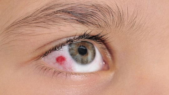Bei einer Blutung im Auge steckt meist nur etwas Harmloses dahinter.