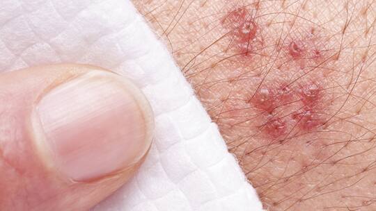 Wenn die Haut brennt