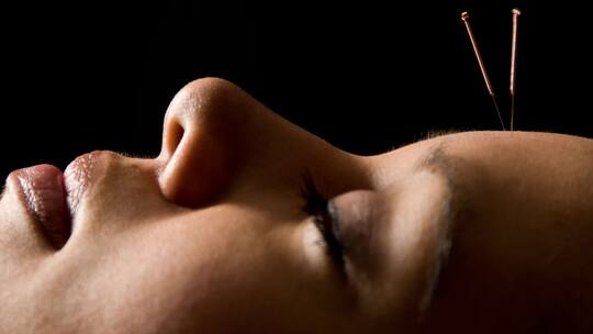 Akupunktur