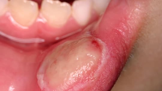 Wunder Punkt im Mund