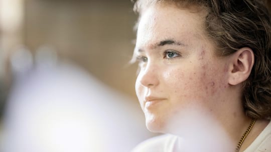 Portrait d’ Agata Strzelczak réalisé chez elle à Miège. Cette jeune fille de 16 ans à survécu à l’incendie du bar le constellation survenu à Crans Montana le 1er janvier 2026. Son corps à été brulé à 65%, six mois après, elle témoi…