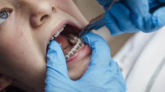 A close up of a teenage girl who is at an orthodontists appointment. She is having her fixed retainer checked and adjusted seeing how her teeth are progressing. The unrecognisable dentist is wearing blue surgical gloves for the examination.