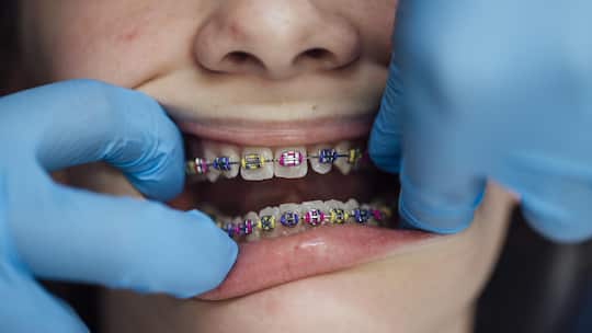 A close up of a teenage girl who is at an orthodontists appointment. She is having her fixed retainer checked and adjusted. Her retainer is a fixed brace with rubber bands in place to keep them progressing.