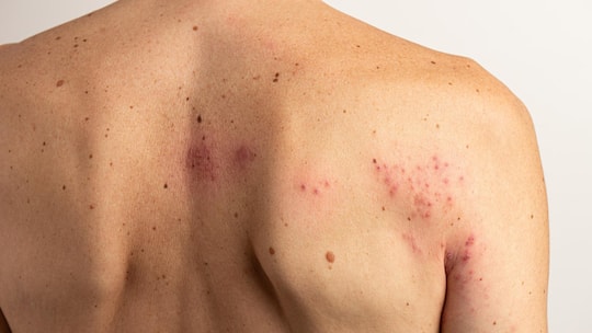 Close up of a man's back and shoulder exhibiting the characteristic rash and blisters of shingles, a reactivation of the varicella zoster virus, causing pain and discomfort