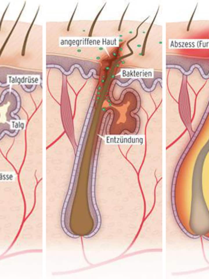 Grafische Darstellung, wie ein Abszess entsteht.