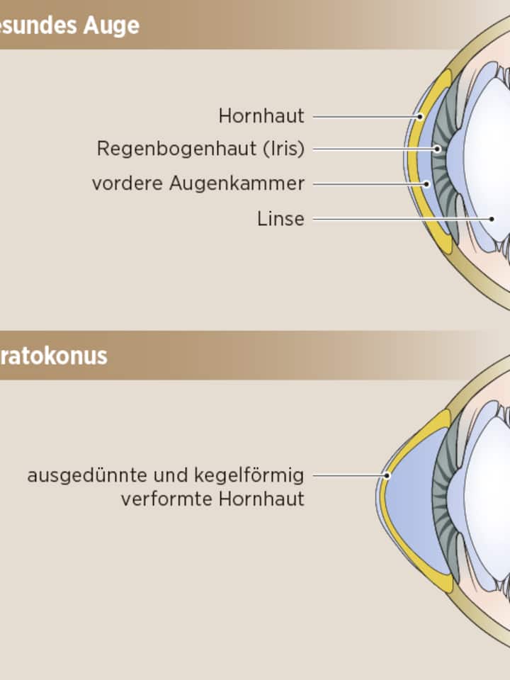Grafische Darstellung eines Keratokonus