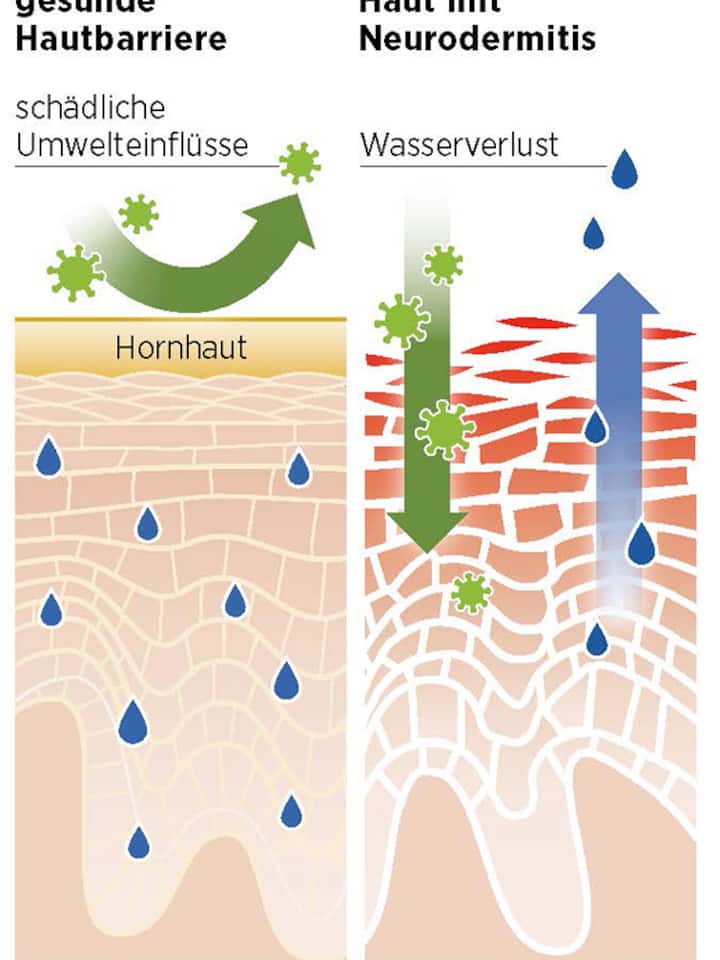 Grafische Darstellung, was auf der Haut bei Neurodermitis passiert.