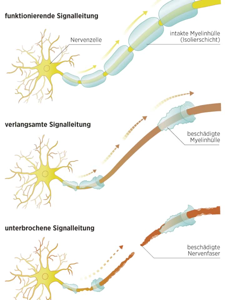 Grafische Darstellung, wie Multiple Sklerose die Nerven schädigt.