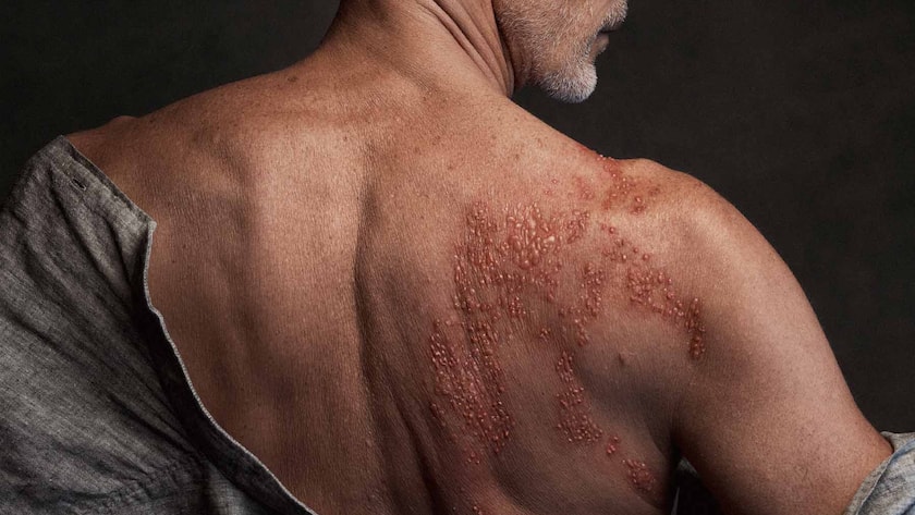 Die Symptome von Gürtelrose können von Patient:in zu Patient:in variieren.