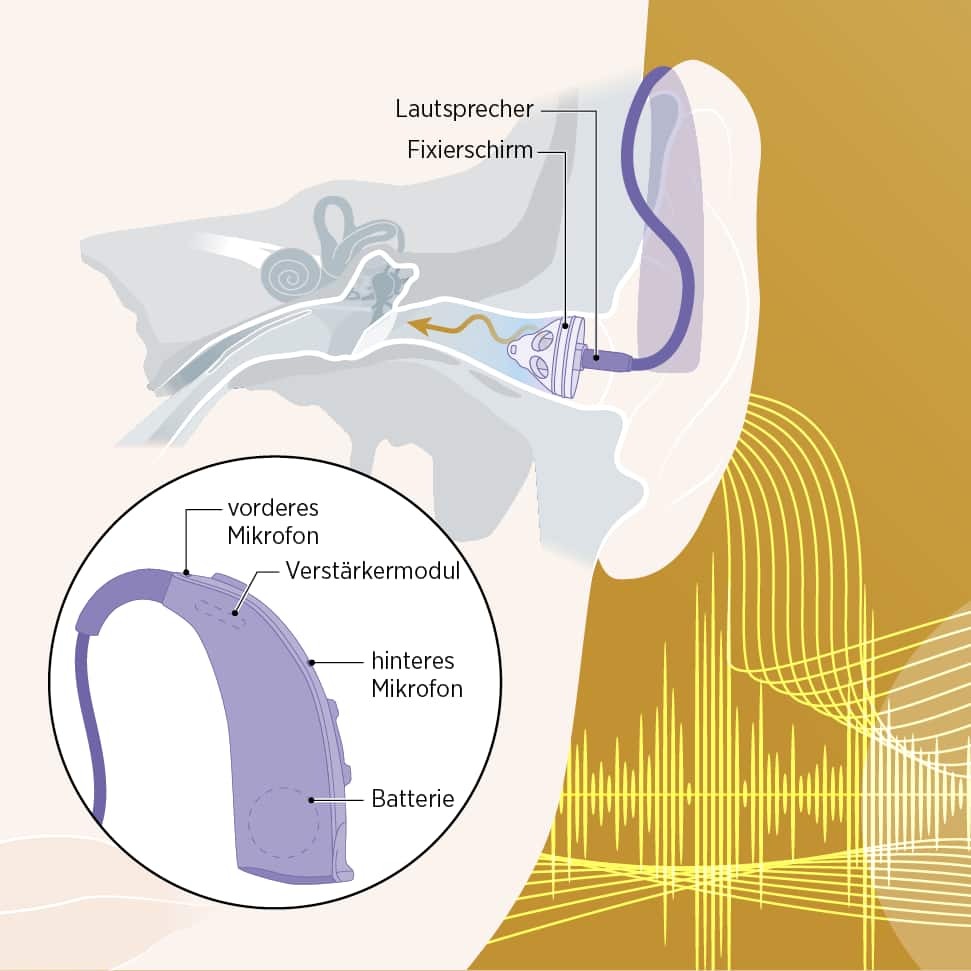 Illustration, wie ein Hörgerät funktioniert