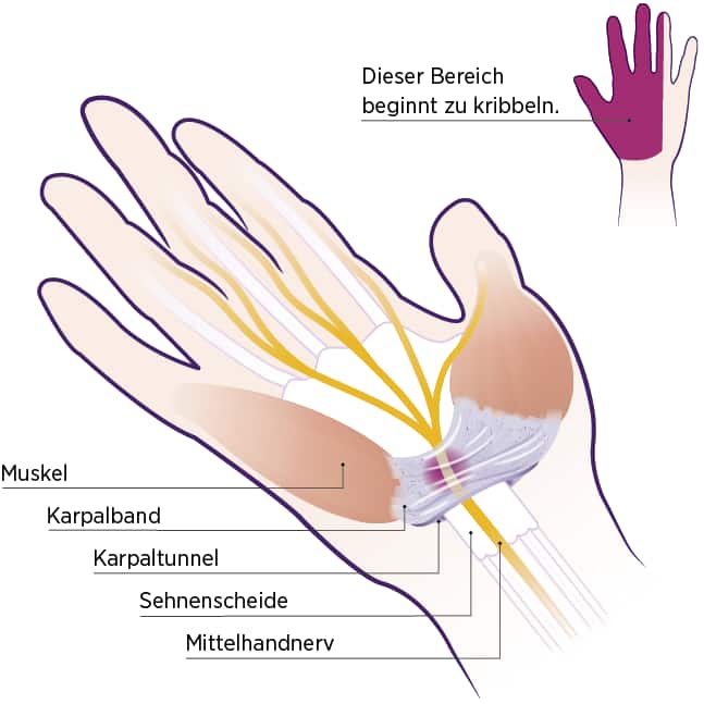 Karpaltunnelsyndrom: Kribbeln in der Hand