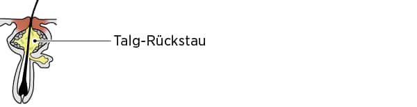 Papulopustulöse Akne