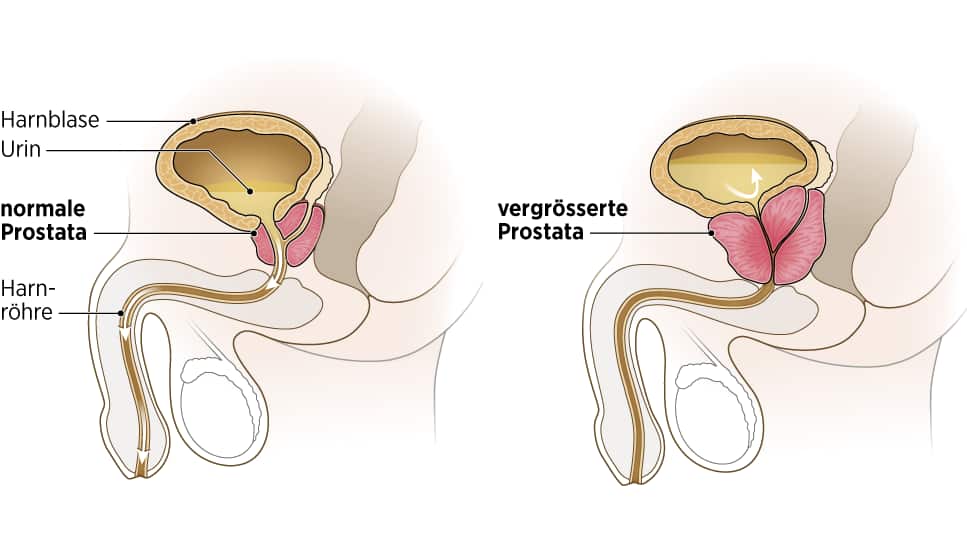 Normal grosse Prostata (links) und vergrösserte Prostata (rechts) im Vergleich.