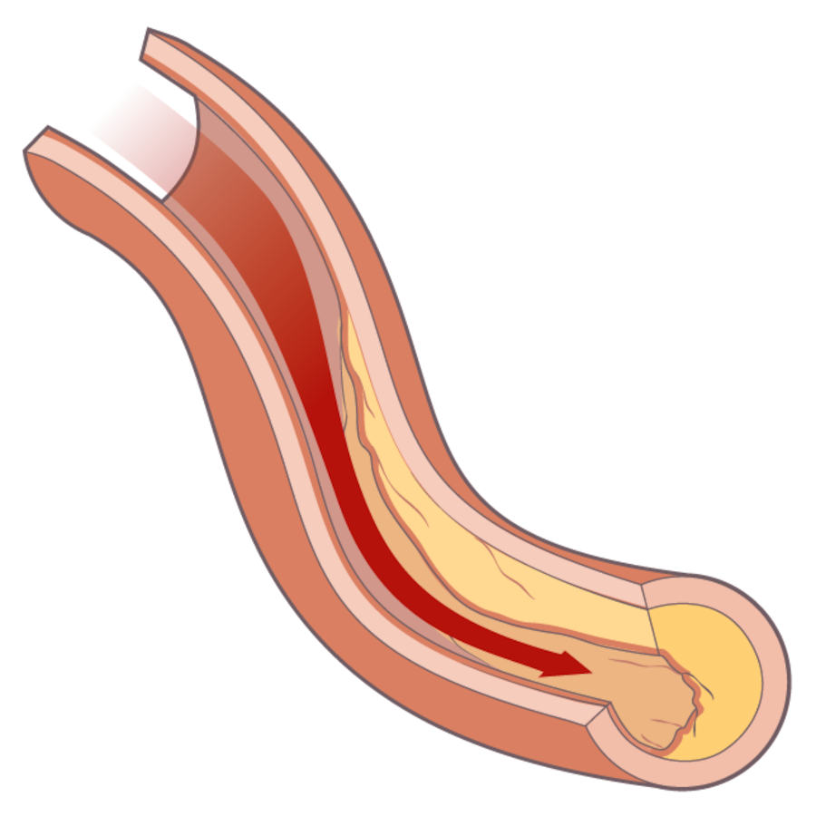 Grafische Darstellung einer Arteriosklerose
