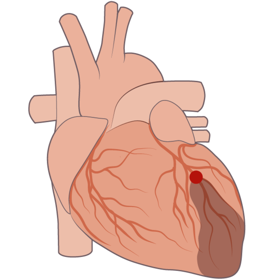 Grafische Darstellung eines Herzinfarktes