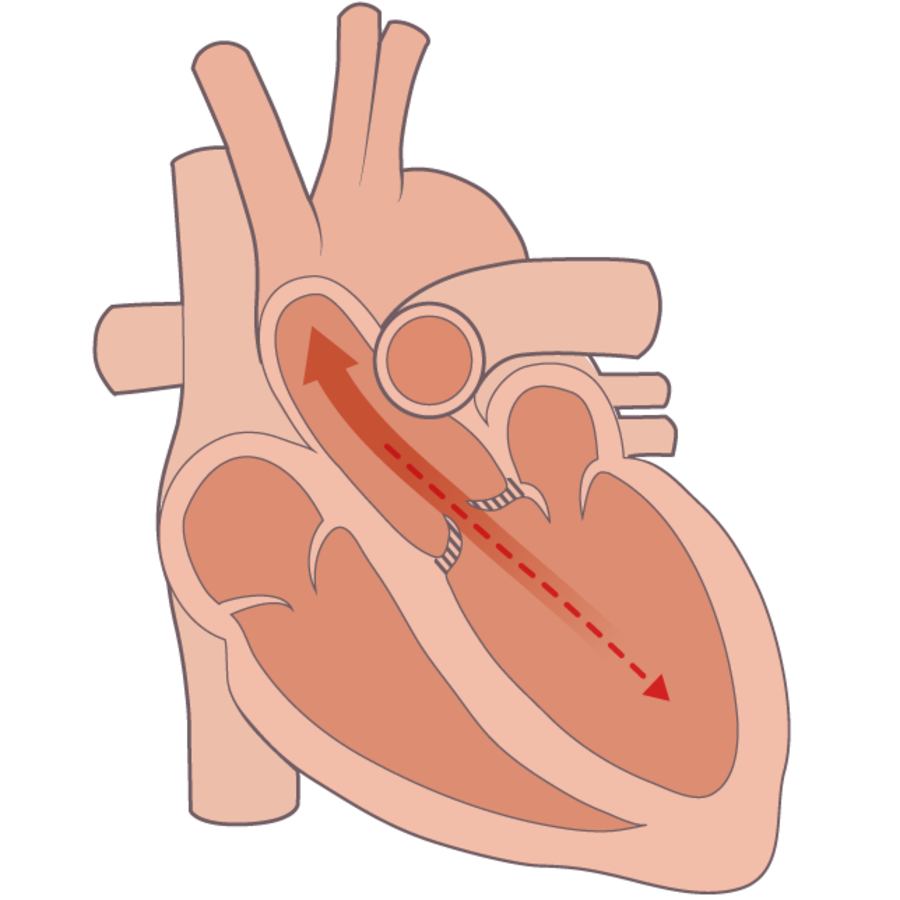 Grafische Darstellung einer Herzklappeninsuffizienz