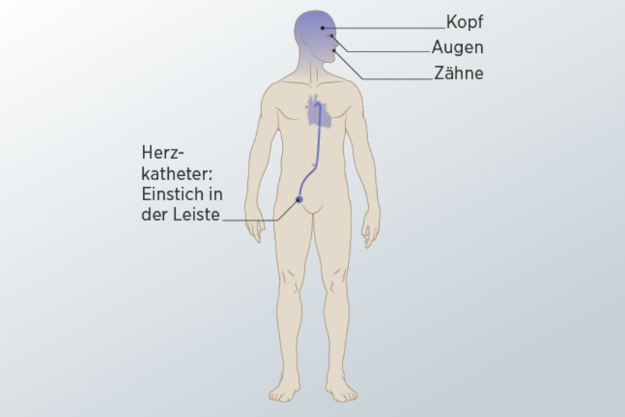Oberflächenanästhäsie