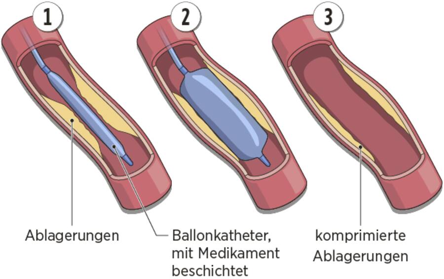 Illustration einer Ballondilatation bei der Schaufensterkrankheit.