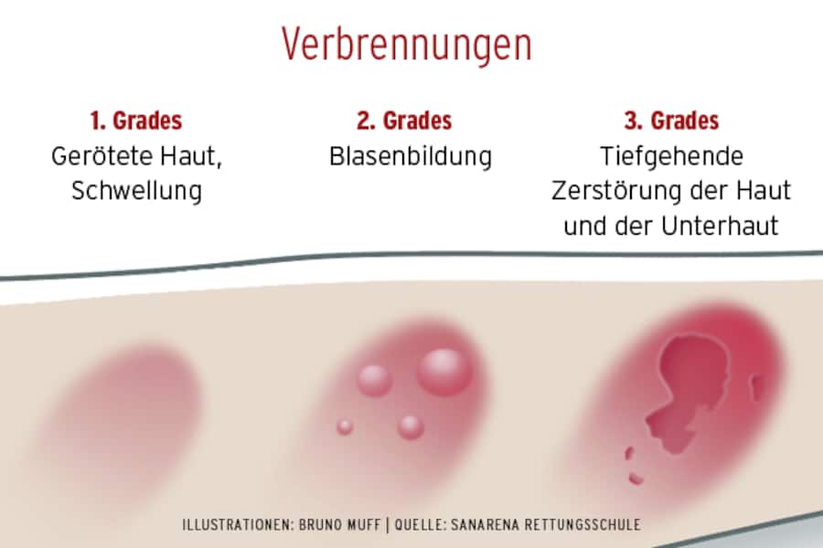 Verbrennung versorgen